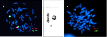 Kromoszóma vizsgálat fluoreszcens jelöléssel Három különböző kromoszóma vizsgálat fluoreszcens jelöléssel, Xq és Xp karok, SE X és XIST jelölések.