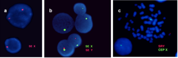 Fluoreszcens in situ hibridizáció a nemi kromoszómák vizsgálatára Három FISH vizsgálat képe, amely a nemi kromoszómák jelenlétét mutatja különböző sejtekben.