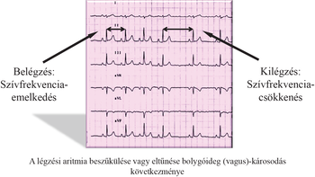 EKG légzési aritmia hatása a szívfrekvenciára EKG-görbe, légzési aritmia hatása a szívfrekvenciára, belégzéskor emelkedés, kilégzéskor csökkenés