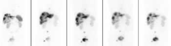 Öt PET/CT felvétel a test aktivitásának vizsgálatára Öt különböző PET/CT felvétel, amelyek a test különböző részein mutatnak aktivitást.